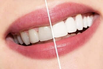 TOP MIẾNG DÁN TRẮNG RĂNG TỐT HIỆU QUẢ NHẤT HIỆN NAY 1 mieng dan trang rang 7 1